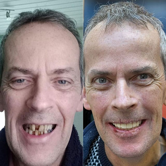 Single tooth implant before and after — case 3