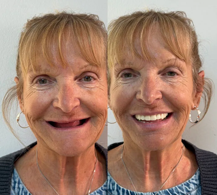 before-after-case-at-dental-implant-centre.jpg