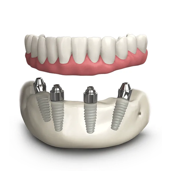 dental-implants.png