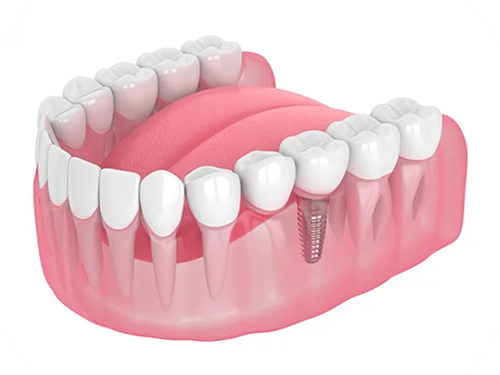 replacing-single-tooth-img