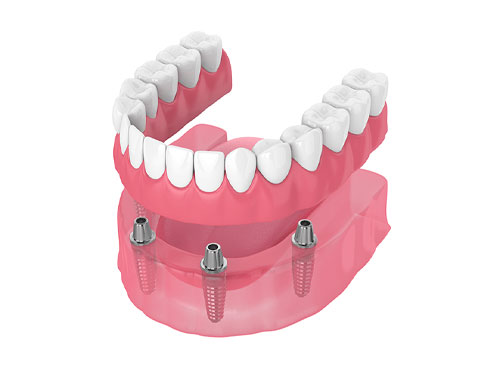 replacing-single-tooth-img