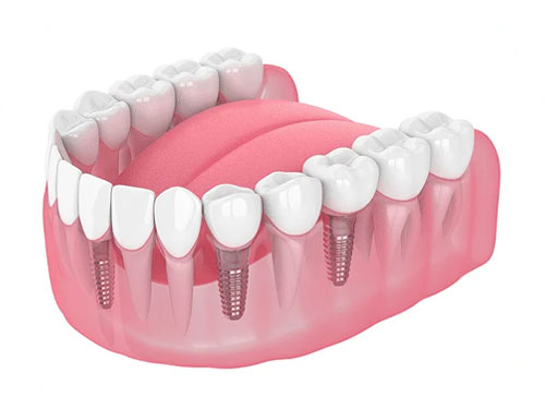 replacing-single-tooth-img