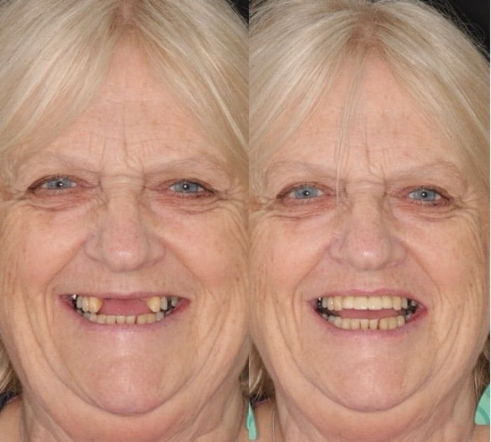 dental-implant-reading.jpeg